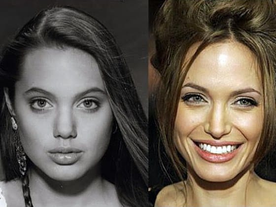 Angelina Jolie Plastic Surgery Before And After 