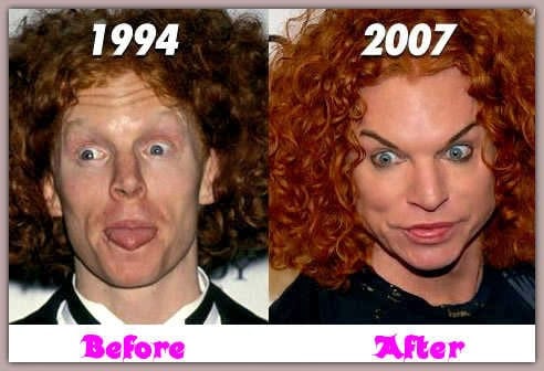 Carrot Top Before Plastic Surgery 
