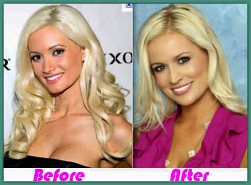 Emily Maynard Nose Job Before And After 