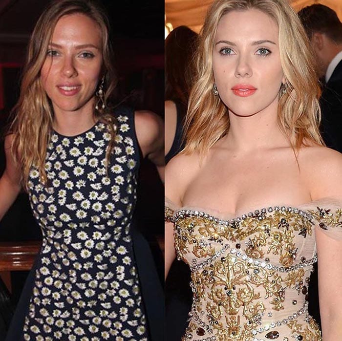 Scarlett Johansson Breast Implants Removed 